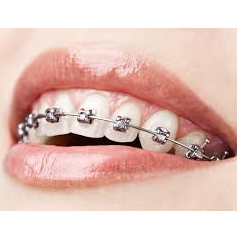 Quels remboursements des mutuelles orthodontie ?