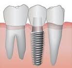 Est-il possible que les frais des implants dentaires soient remboursés par sa mutuelle?