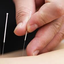 Mutuelles santé : y a-t-il un remboursement pour l’acupuncture ?