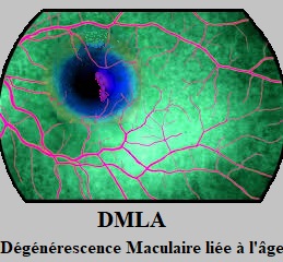 Santé des personnes âgées : le DMLA