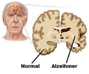 Santé des personnes âgées : la maladie d’Alzheimer