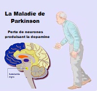 Santé des personnes âgées : la maladie de Parkinson