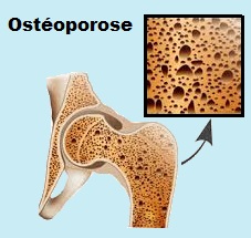 Santé des personnes âgées : l’ostéoporose