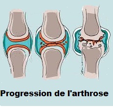 Santé des personnes âgées : l’arthrose