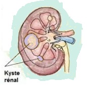 Santé des  seniors : les kystes rénaux