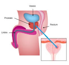 Mutuelle santé senior : le cancer de la prostate