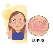 Mutuelle santé senior : le lupus